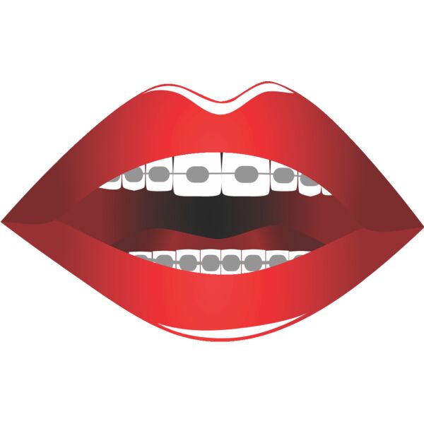 Lips Braces 1 Thumbnail